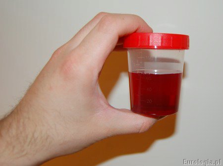 Krwiomocz - pojemnik z próbką moczu