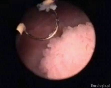 TURT - przezcewkowa resekcja guza pęcherza moczowego